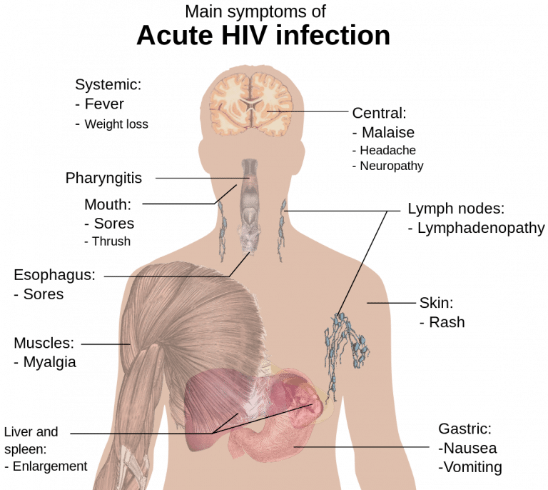 hiv-clinical-features-management-teachmeobgyn