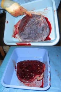 Fig 2 - Human placenta, maternal side (bottom) and foetal side (top).