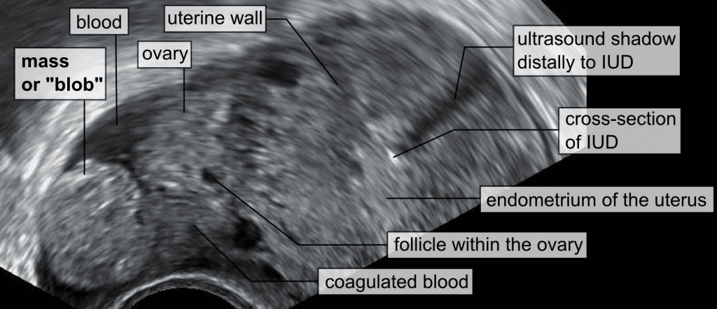 Ectopic Pregnancy - Rupture - Symptoms - Management - TeachMeObGyn