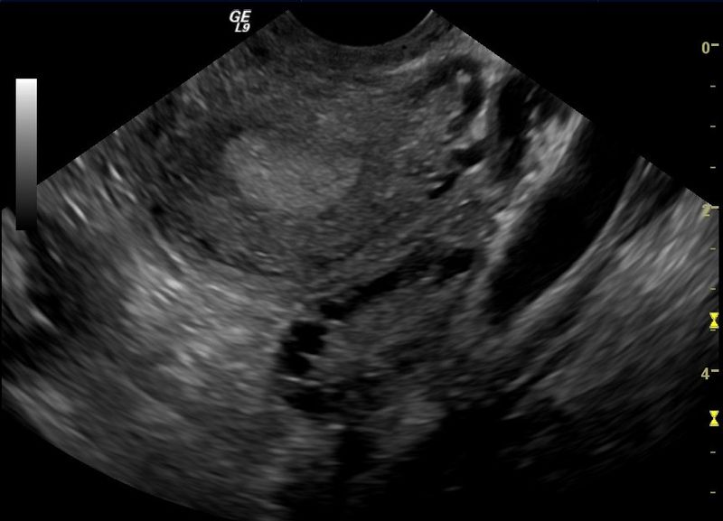 Polycystic Ovary Syndrome Pcos Fertility Ultrasound Teachmeobgyn