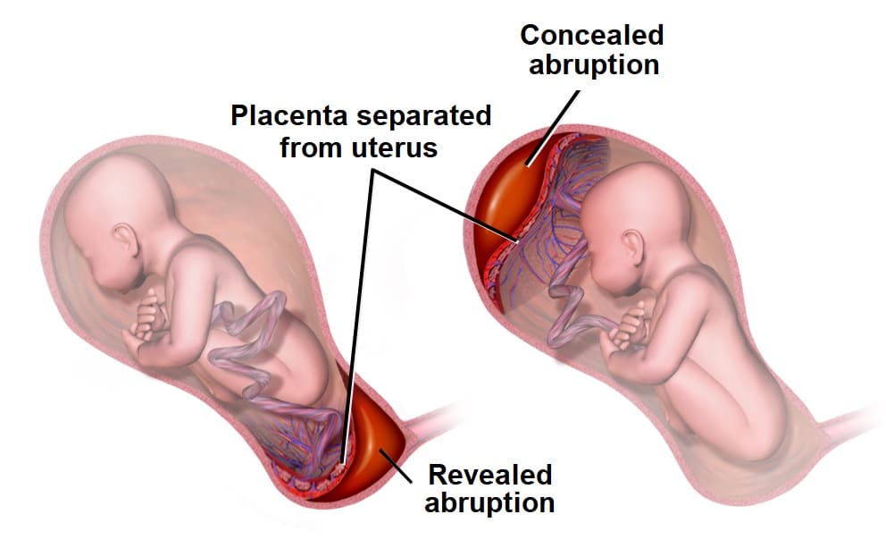 placental-abruption-causes-clinical-features-management