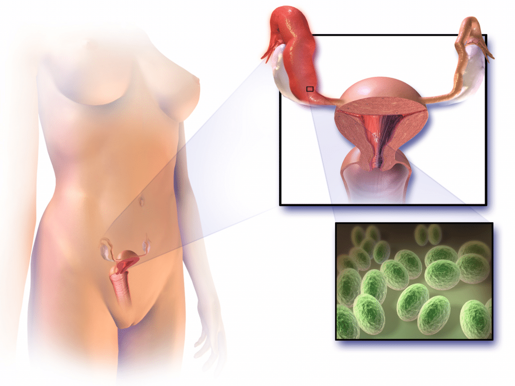 Fig 1 - Pelvic inflammatory disease refers to infection of the upper female genital tract.