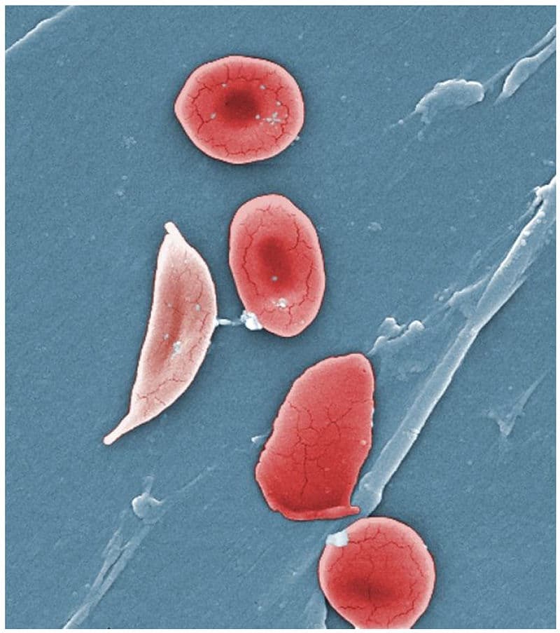 Fig 2 - Coloured scanning electron micrograph, showing a sickled red blood cell.