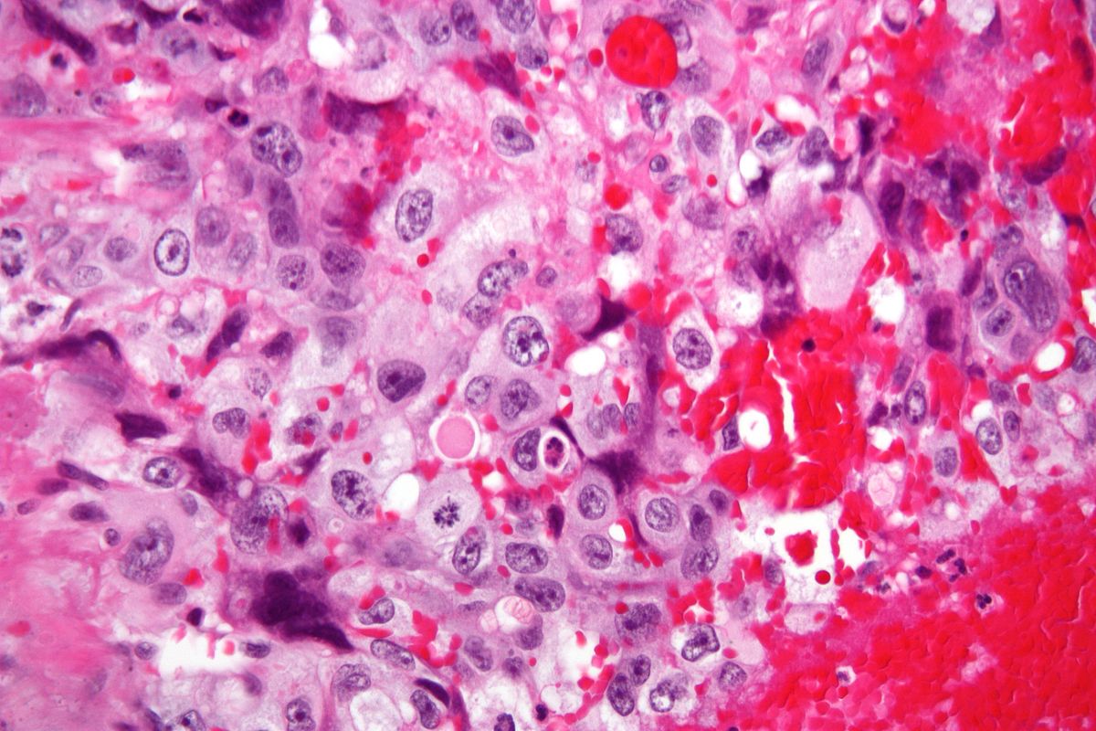 Fig 1 - High magnification image of choriocarcinoma. The cell population consists of cytotrophoblasts and syncytiotrophoblastics