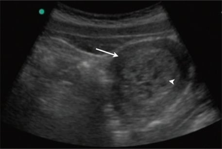 Fig 2 - Complete mole on transabdominal ultrasound of the pelvis. The uterus (arrow) is shown with multiple cystic areas within an enlarged echogenic endometrial cavity (arrowhead).
