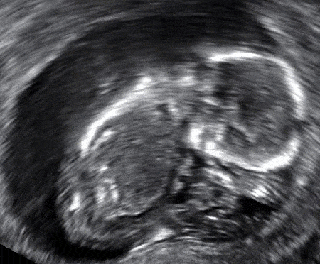 Fig 3 - Ultrasound of a fetus with a CRL of 67mm. The heart is visible, but there is no heartbeat - this is a missed miscarriage.