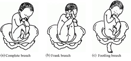 Fig 1 - The different types of breech presentation.