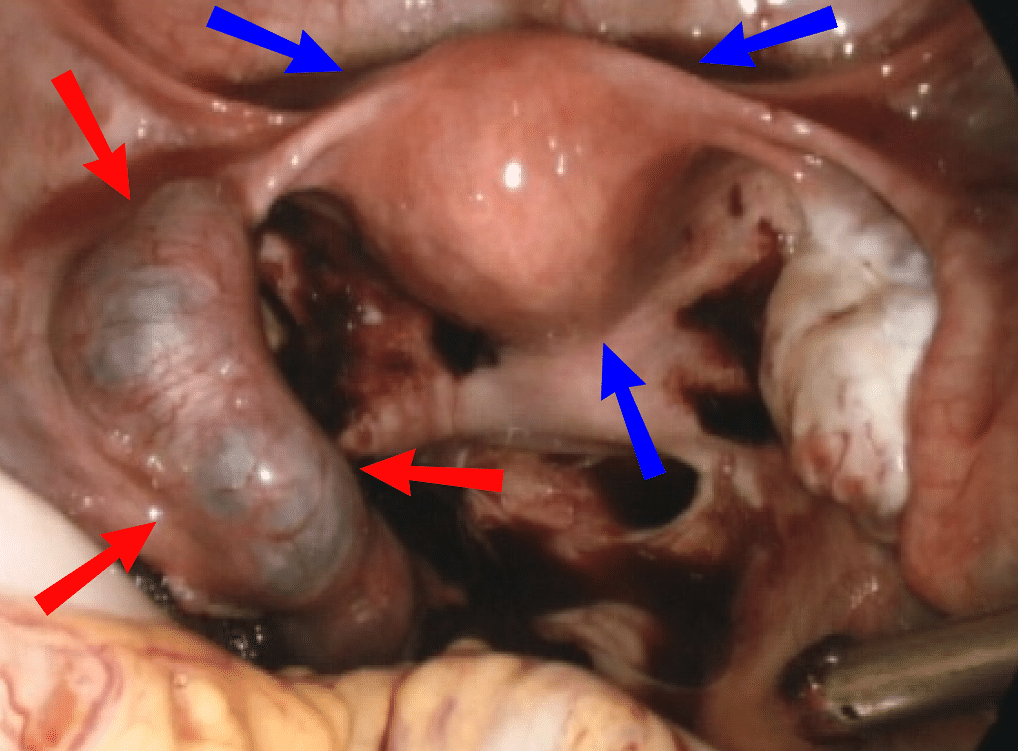Fig 4 - Laparoscopic view of ectopic pregnancy within the left fallopian tube (red arrows). Uterus marked by blue arrows.