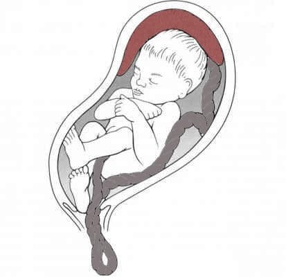 Fig 1 - A footling breech and umbilical cord prolapse.