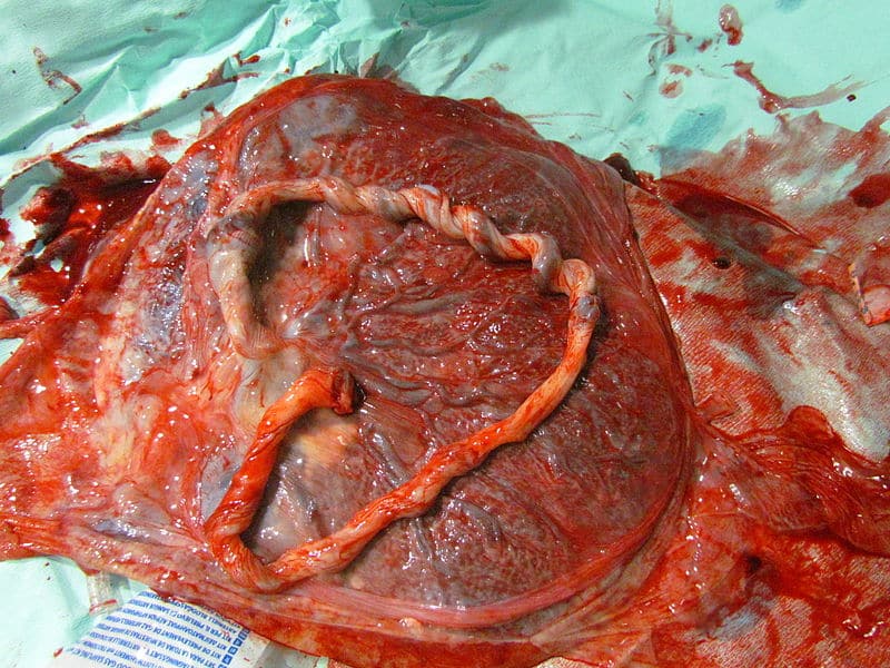 Fig 2 - A complete placenta. In the assessment of post-partum haemorrhage, the placenta should be examined.
