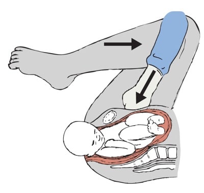 Fig 2 - The McRoberts manoeuvre - hyperflexion of the legs to increase the AP diameter of the pelvis.