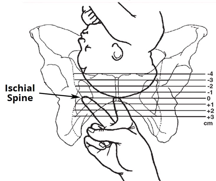 Fig 3 - Measuring the station of the fetus, in relation to the ischial spines.