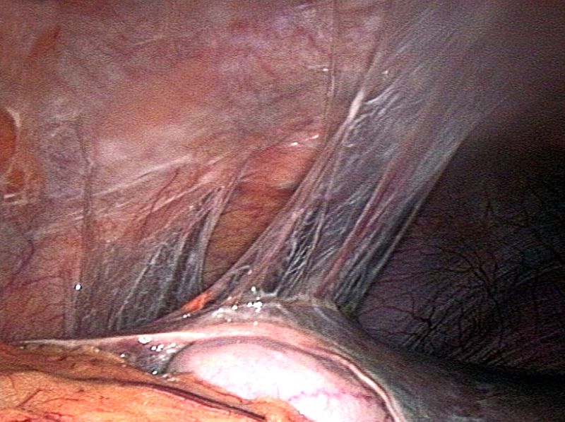 Fig 4 - Perihepatic adhesions observed on laparoscopy - a complication of PID.