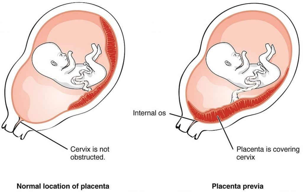 Fig 1 - Placenta praevia, where the placenta is inserted into the lower uterine segment. It is an important risk factor for post-partum haemorrhage.