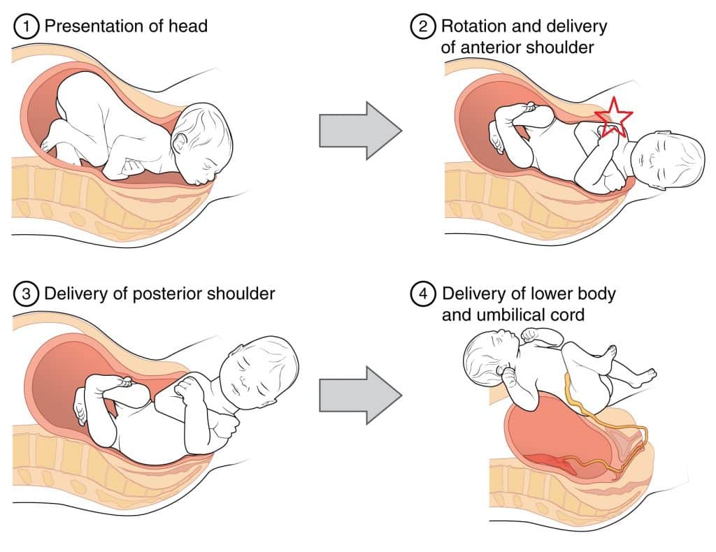 Fig 1 - The stages of normal childbirth. Shoulder dystocia commonly occurs at stage 2, where the anterior shoulder becomes impacted on the maternal pubic symphysis.