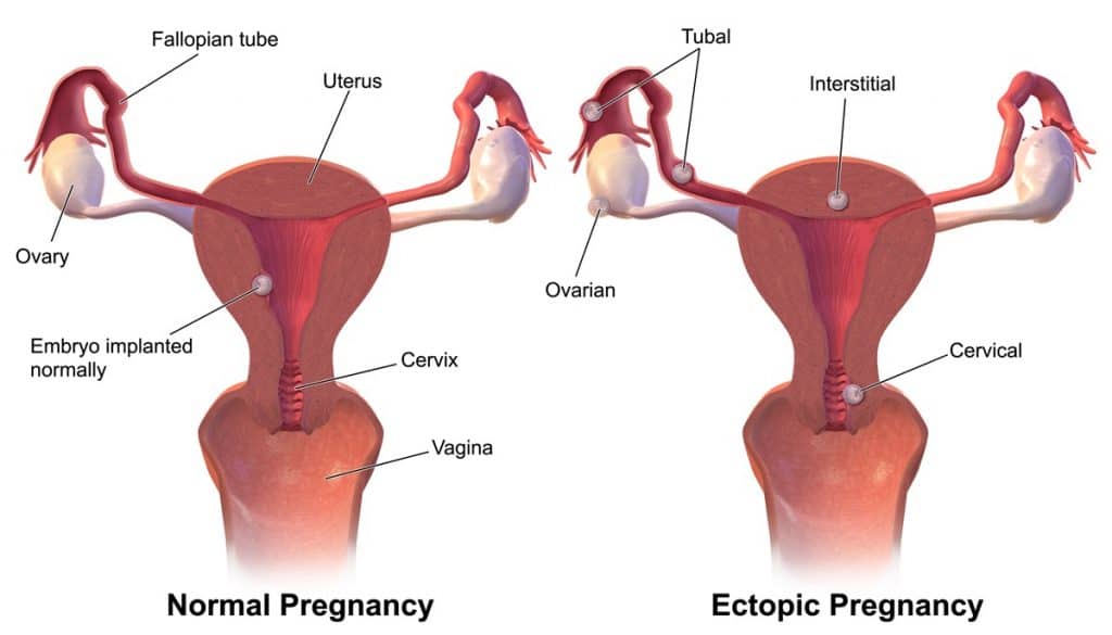 Fig 1 - An ectopic pregnancy is one that is implanted outside the uterine cavity.