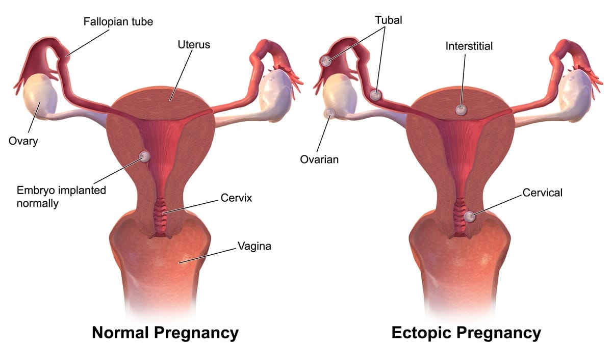 Symptoms of a ruptured ovarian cyst