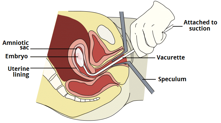 Fig 4 - Vacuum aspiration; a procedure used in the surgical management of miscarriage.