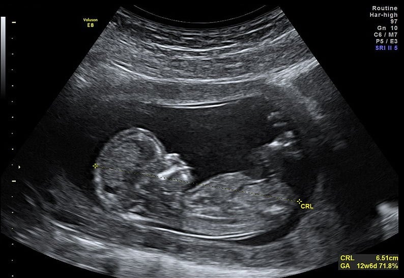Fig 1 - Ultrasound scan of a pregnancy at 12 weeks, showing the measurement of the crown-rump length.