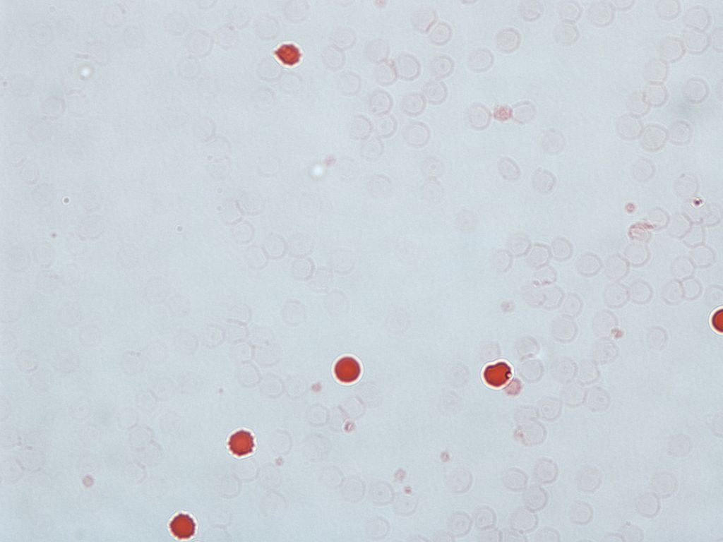 Fig 2 - The Kleihauer test. Fetal RBCs are visible as red, while the adult cells are seen as "ghosts"