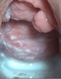 Vulvovaginal Candidiasis TeachMeObGyn