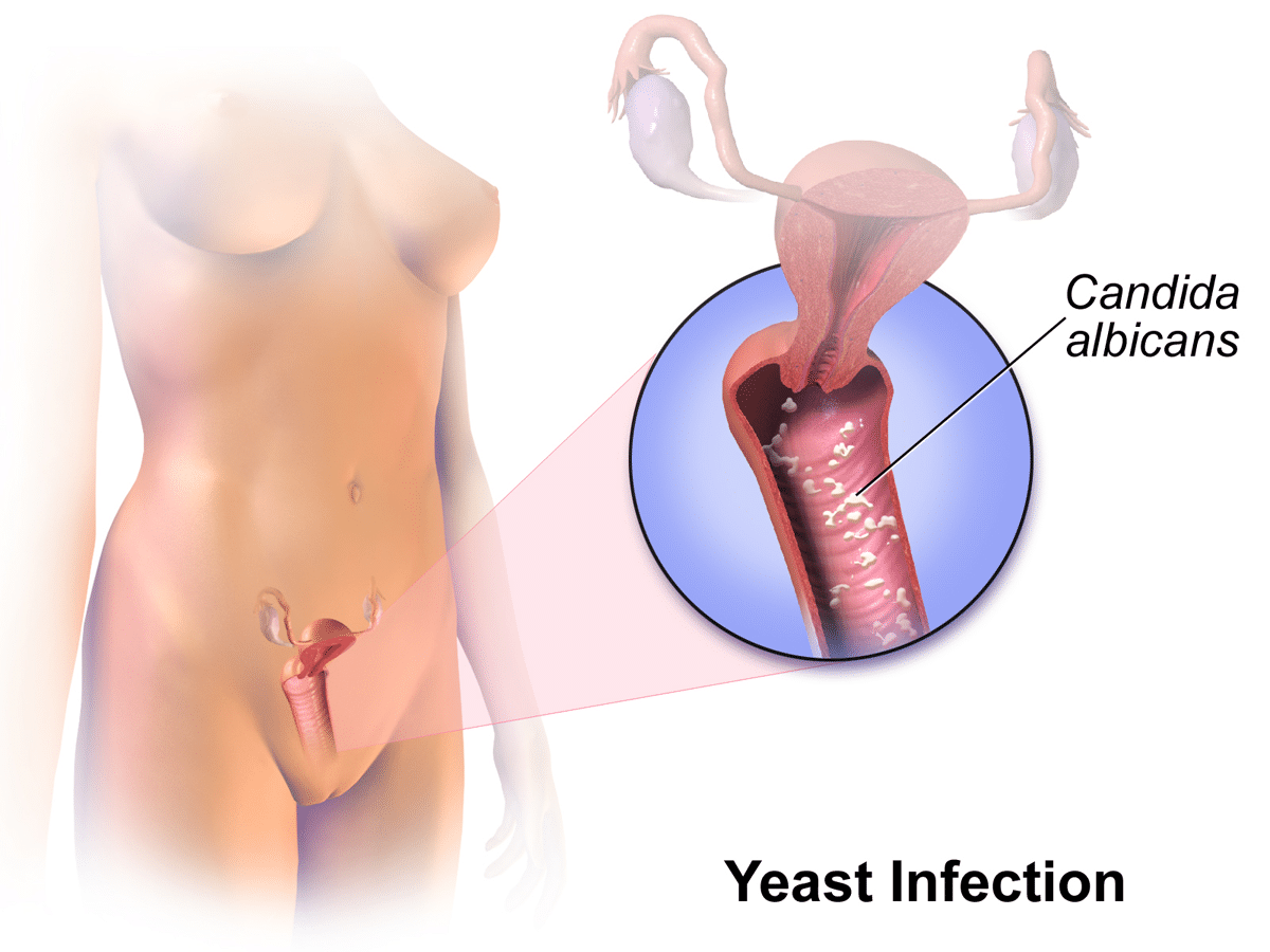 yeast infection men genital