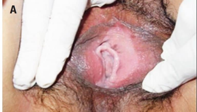 Vulvar and vaginal lesions