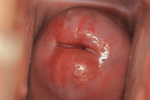 Fig 2 - Cervical ectropion on speculum examination.