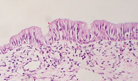 Fig 1 - Normal columnar epithelium of the cervix. Cervical polyps result from focal hyperplasia of this epithelial layer.
