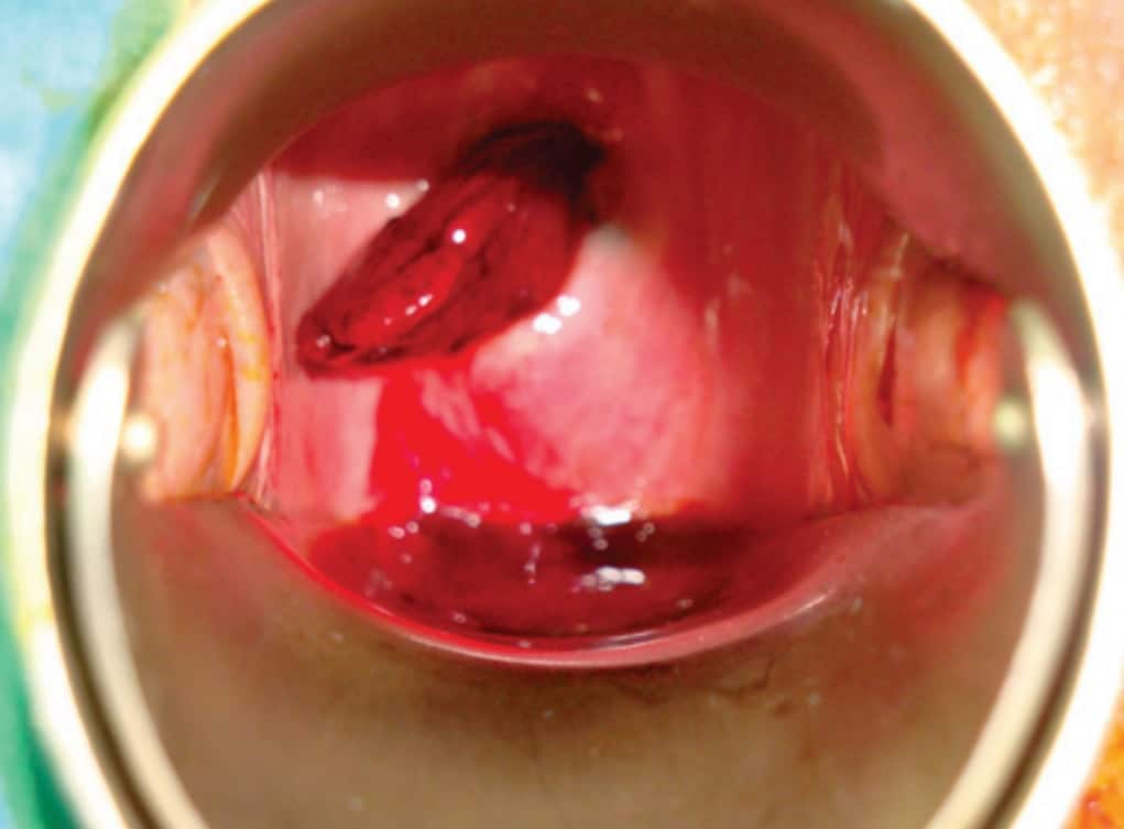 Diagnostic pathway for women presenting with postmenopausal bleeding.