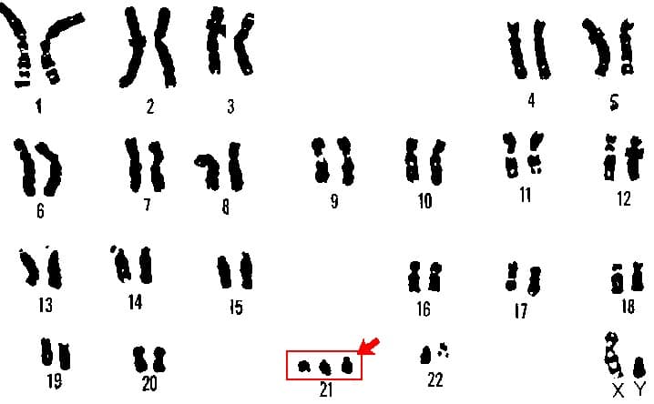 Fig 1 - Karyotyping performed on the products of conception, showing trisomy 21 - a embryonic genetic abnormality that is a strong risk factor for miscarriage.