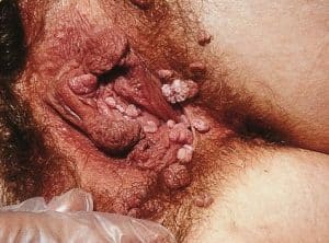 Fig 1 - Female genital warts