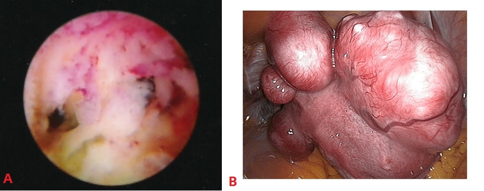Fig 3 - Examples of uterine structural abnormalities. A - Intrauterine adhesions, visible on hysteroscopy. B- Uterine fibroids, visible on laparoscopy.