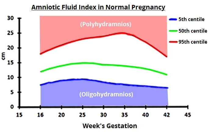 Fig 1 - Amniotic fluid centiles during pregnancy. Polyhydramnios is over the 95th centile, oligohydramnios is below the 5th centile