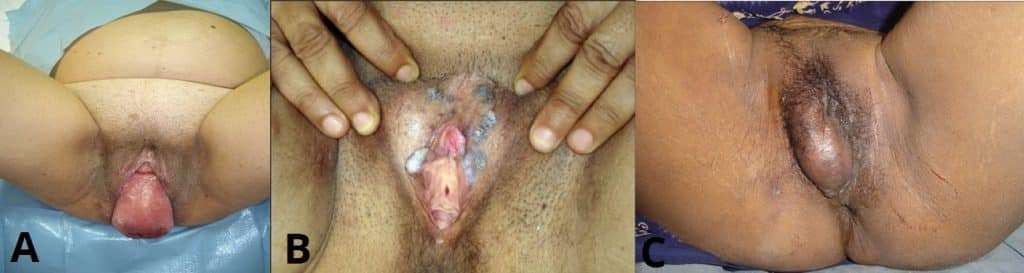 Sequedad vaginal remedio casero