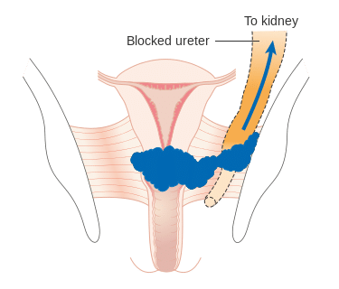 What's an IUD insertion like?
