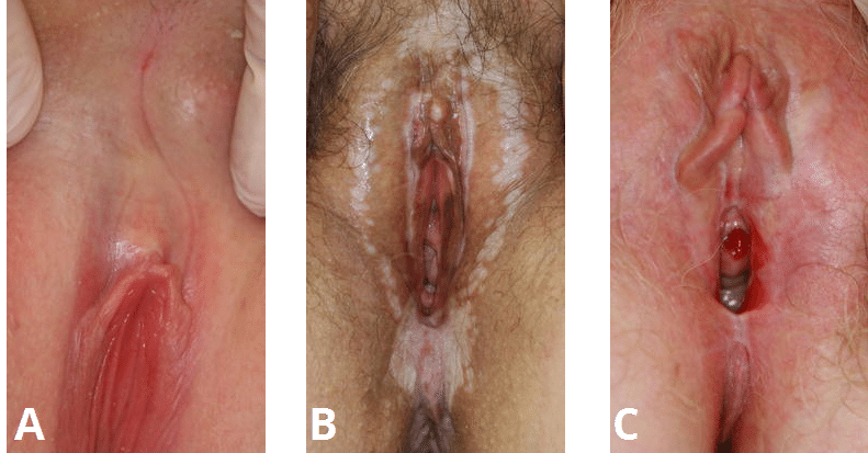 Fig 1 - The clinical features of lichen sclerosus. A) Clitoral hood fusion. B) White patches in a figure of 8 distribution. C) Introital erosions