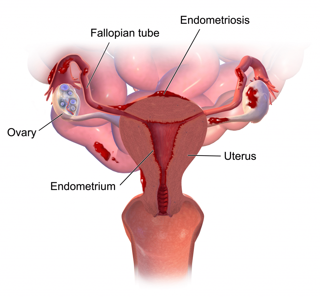 Symptoms prevalent according to location of endometriosis implants