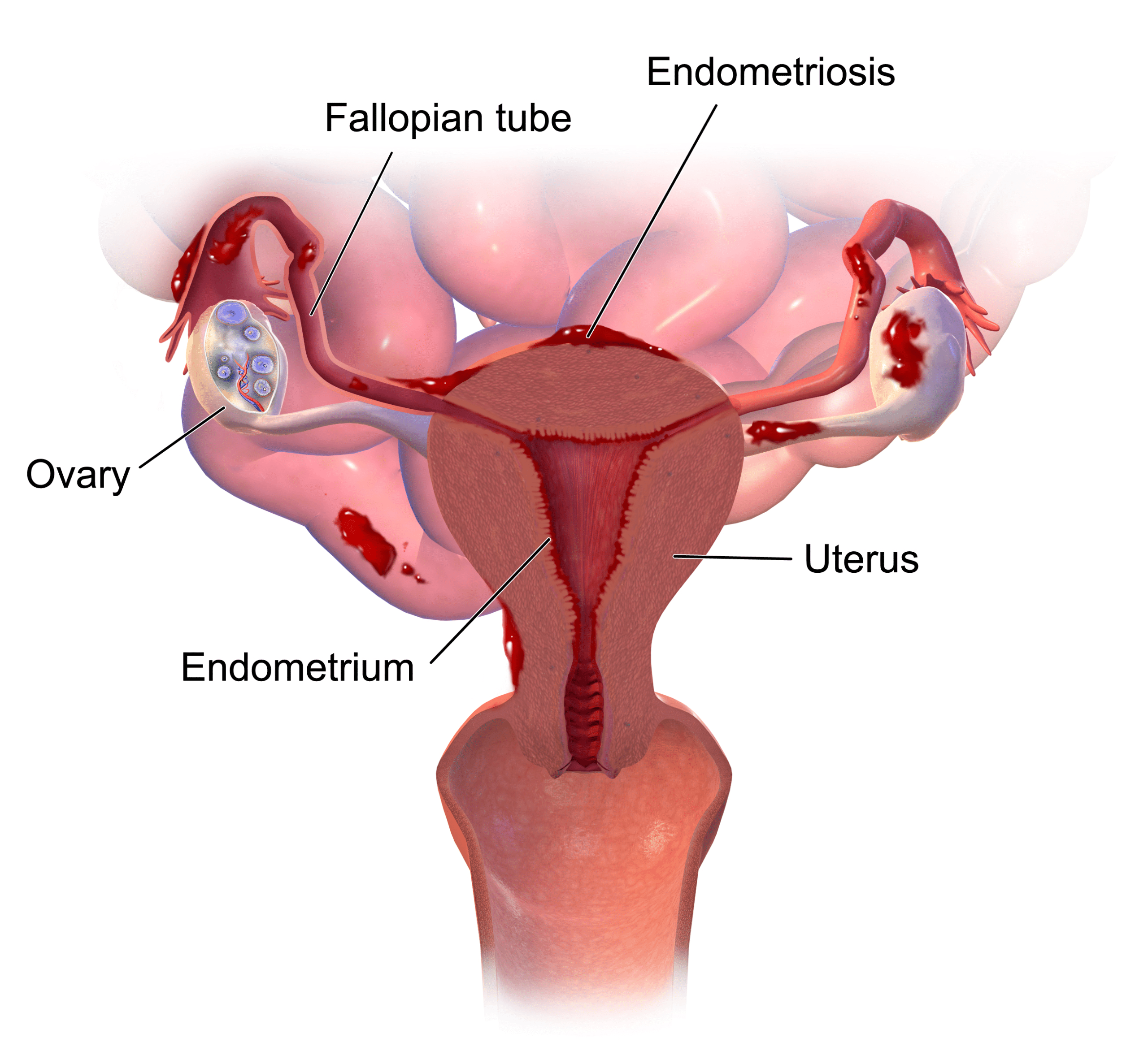 what causes endometriosis, Several Proposed Theories