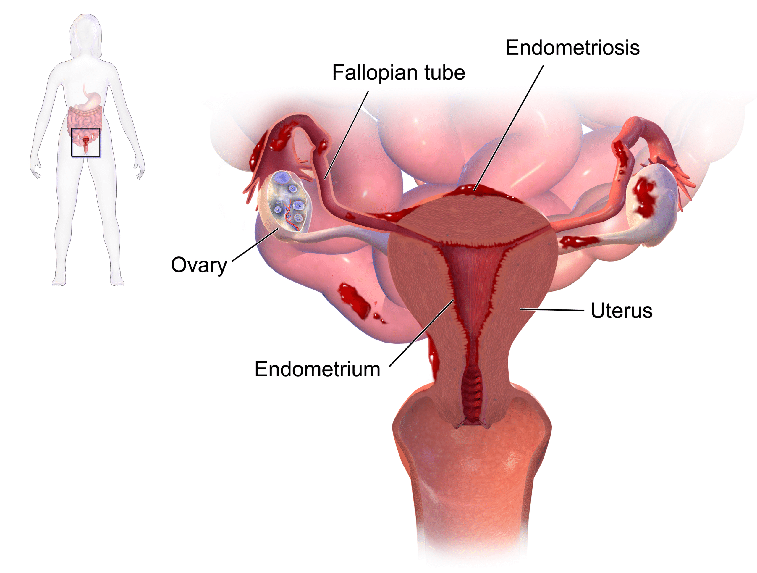 Endometriosis - Clinical Features - Diangosis - TeachMeObGyn