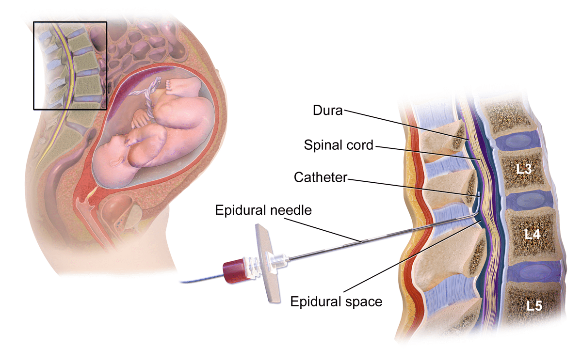 Fig 2 - Epidural anaesthesia is often used in elective caesarean section.