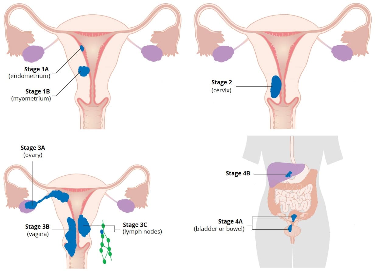endometrial cancer and pregnancy)