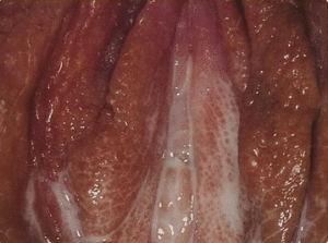 Figure 1. Vaginal discharge in female gonorrhoea infection