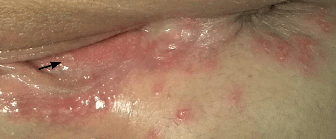 genital herpes men first signs