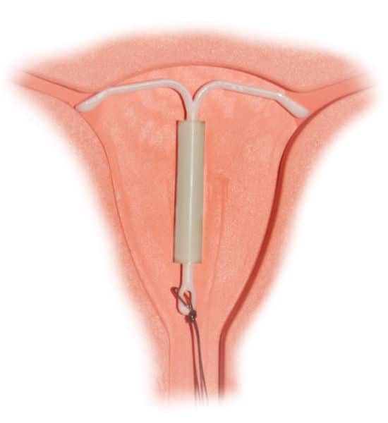 Fig 3 - The mirena intrauterine system, part of the pharamacological management of heavy menstrual bleeding.
