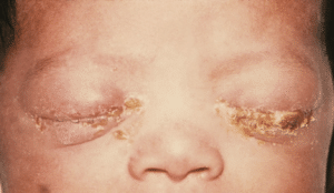 Figure 2. Neonatal conjunctivitis may develop if born to an untreated woman with gonorrhoea.