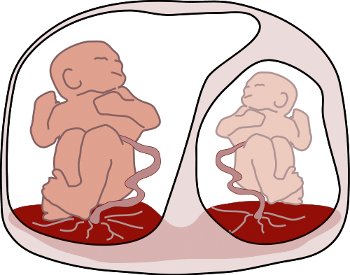 Fig 2 - Twin to twin transfusion syndrome, a complication of a disproportionate blood supply in twin pregnancies. It is a cause of polyhydramnios.