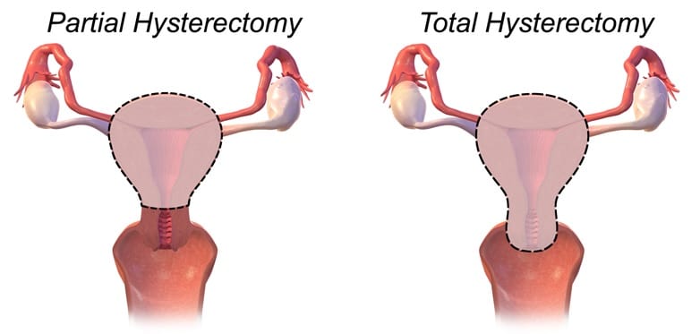 Fig 4 - Partial (subtotal) and total hysterectomy. 