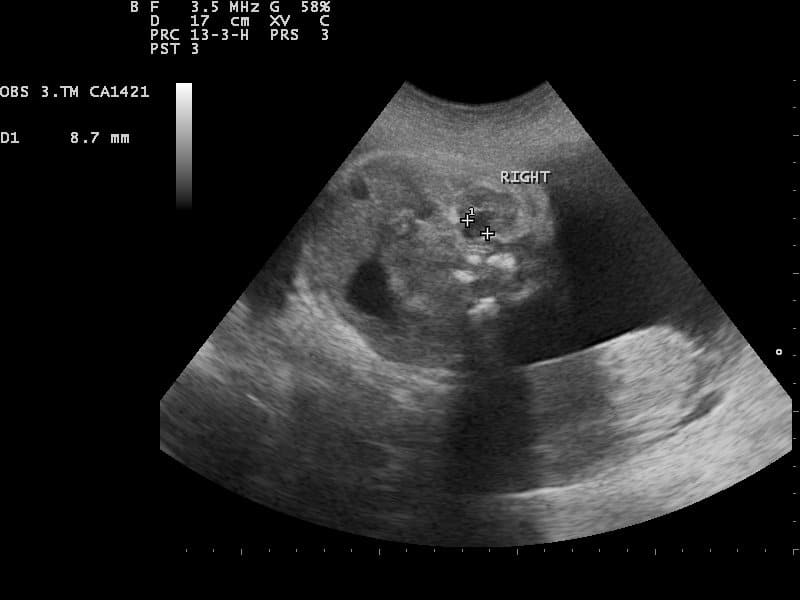 Fig 2 - Ultrasound image of normal fetal kidney. In cases of oligohydramnios, the kidneys should be assessed.