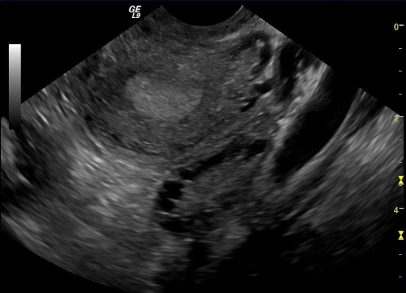 Polycystic Ovary Syndrome Pcos Fertility Ultrasound Teachmeobgyn 